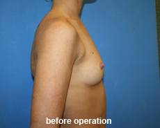 plastic-surgery-breast-augmentation